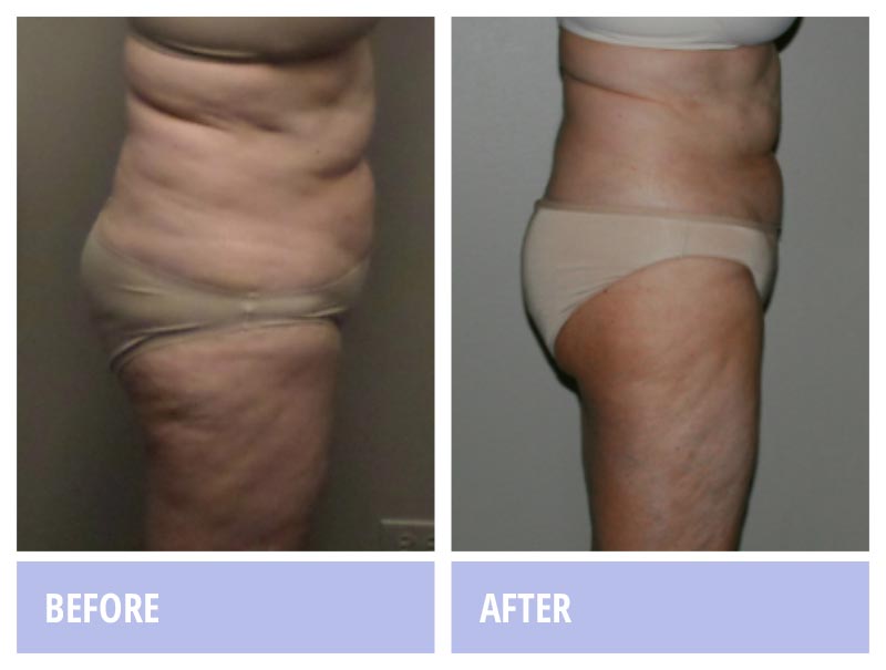 Liposuction (lipoplasty/ lipo/ body contouring surgery ) - Zaria